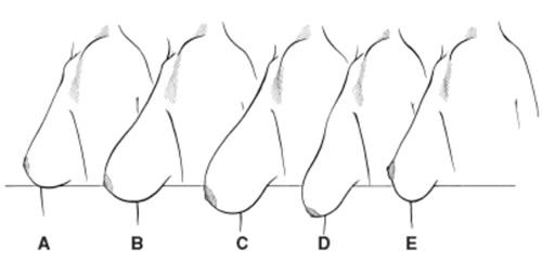 STOP BOOB SAG NATURALLY!